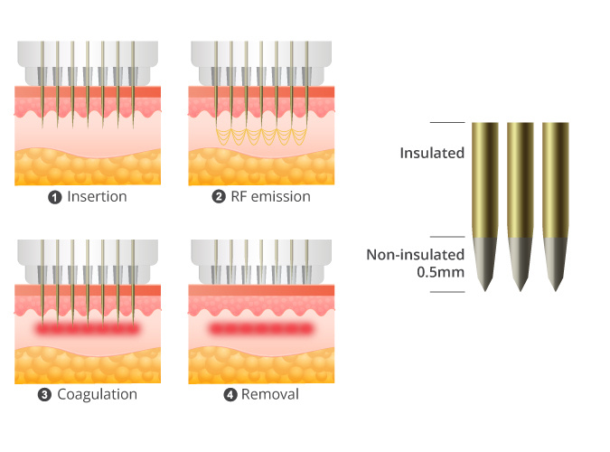 Аппарат микроигольчатого RF лифтинга Dermatrix DUO (GSD) фото 5