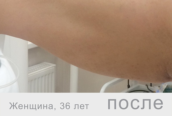 Lift, 10мл. (Франция) фото 3