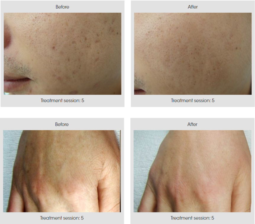 Renas (1550 нм) – фракционный эрбиевый лазер для омоложения и лечения рубцов фото 6