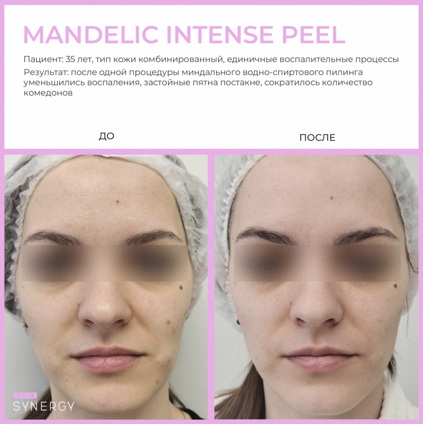 Пилинг Миндальный Интенс\ Mandelic Intense Peel, флакон 30 мл фото 5